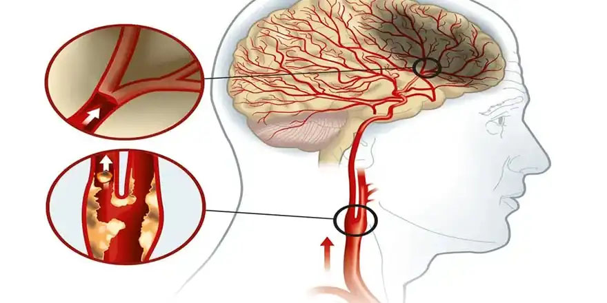 سونوگرافی عروق مغزی و گردن