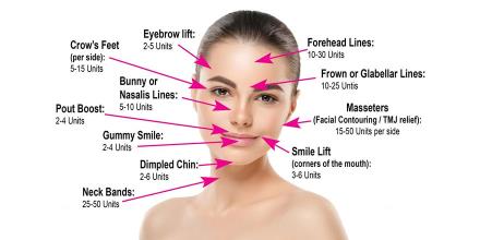 تزریق بوتاکس جهت زیبایی